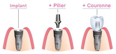 Composants implant dentaire Courbevoie Becon
